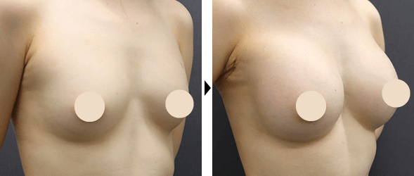 シリコンバッグ豊胸（モティバ）