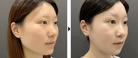 骨切り（輪郭3点）＋バッカルファット除去