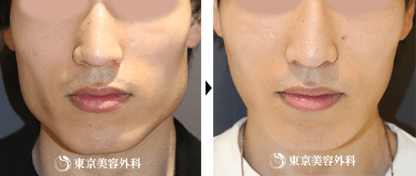 小顔・輪郭整形