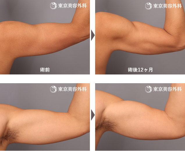 二の腕マッスル脂肪吸引
