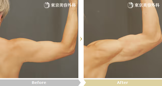 中居弘一医師による二の腕マッスル脂肪吸引の症例