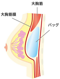 大胸筋下法