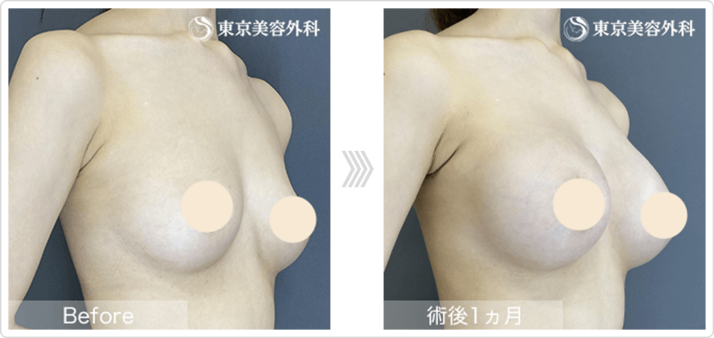 乳腺下法の症例写真