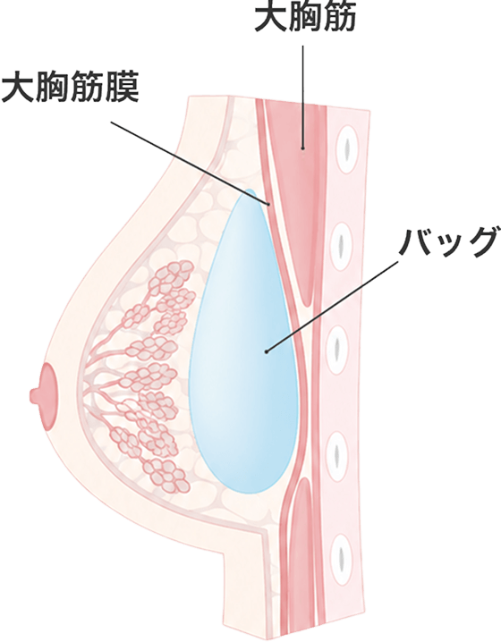 乳腺下法の施術イメージ