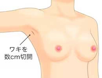ワキを数cm切開