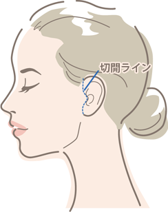 MACSリフト(ミニリフト)