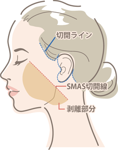 SMASフェイスネックリフト