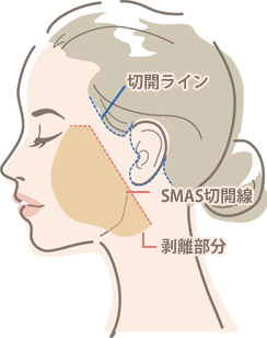 High SMASフェイスネックリフト