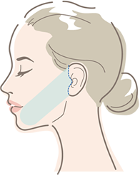 切開範囲「ミニ」