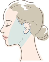 切開範囲「フルフェイス」