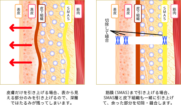 皮膚だけを引き上げる場合、表から見える部分のみを引き上げるので深層ではたるみが残ってしまいます。筋膜(SMAS)まで引き上げる場合、SMAS層と皮膚組織も一緒に引き上げて、余った部分を切除・縫合します。