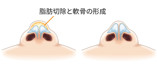 丸い鼻先・団子鼻の調整