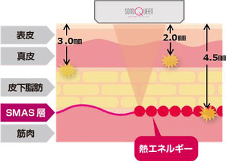 ソノクイーン（sonoQueen）のアプローチイメージ