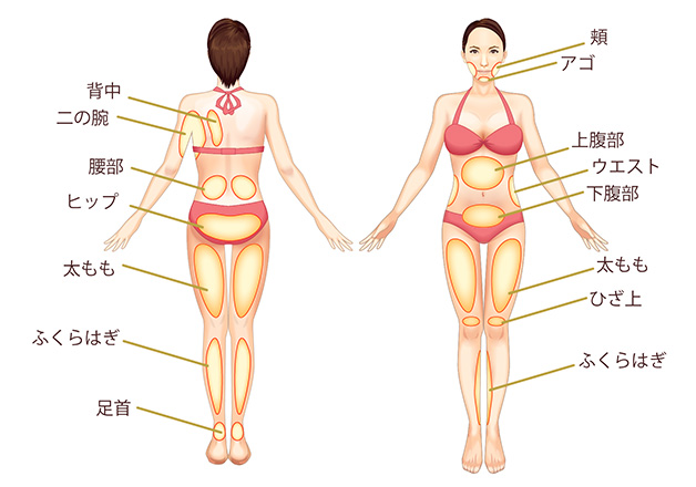 医療痩身ができる部位