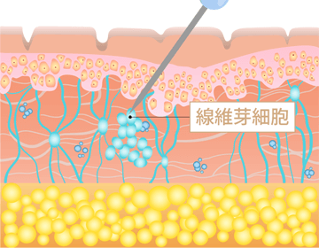 真皮線維芽細胞の移植