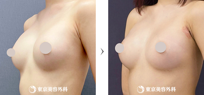 アクアフィリング除去とバッグ豊胸