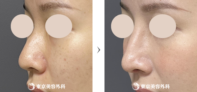 鼻形成（ビフォーアフター）