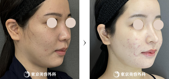 輪郭形成（ビフォーアフター）